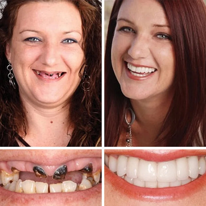 Medical Full Denture with Strong Suctiond🦷